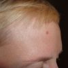 生え際が薄い原因は？女性にも発生する生え際から始まる薄毛の原因を紹介！対策方法やクリニックでの治療方法を知ろう！