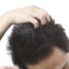 脂漏性湿疹が頭と頭皮に出来たときの対処法は？自分で出来る頭皮ケアを紹介！