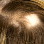 円形脱毛症は女性にも発症する！その原因や症状、治療方法を知ろう！