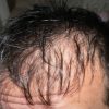 全身の毛が抜け落ちる汎発性脱毛症は治るの？原因や治療法について紹介！