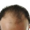 AGAの薄毛の原因ジヒドロテストステロンってなに？DHTを汗で減らす方法を紹介！
