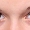 眉毛のハゲは円形脱毛症の症状かも！治療期間と対策方法を紹介